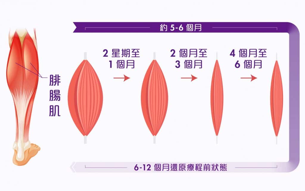 圖解說明Botox治療後的腿部肌肉恢復過程，從約5至6個月的時間內，顯示腓腸肌的變化和增長，適合對脂肪減少療程有興趣的消費者。