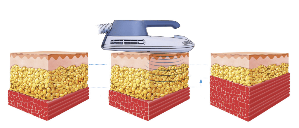 脂肪減少過程示意圖，展示設備對皮膚、脂肪及肌肉層的作用，強調非侵入性治療技術。