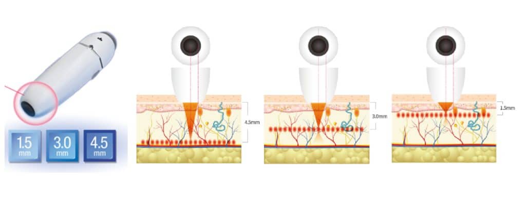 展示不同深度的皮膚治療儀器，並標示針頭深度（1.5mm、3.0mm、4.5mm），適合用於皮膚美容技術的介紹與說明。