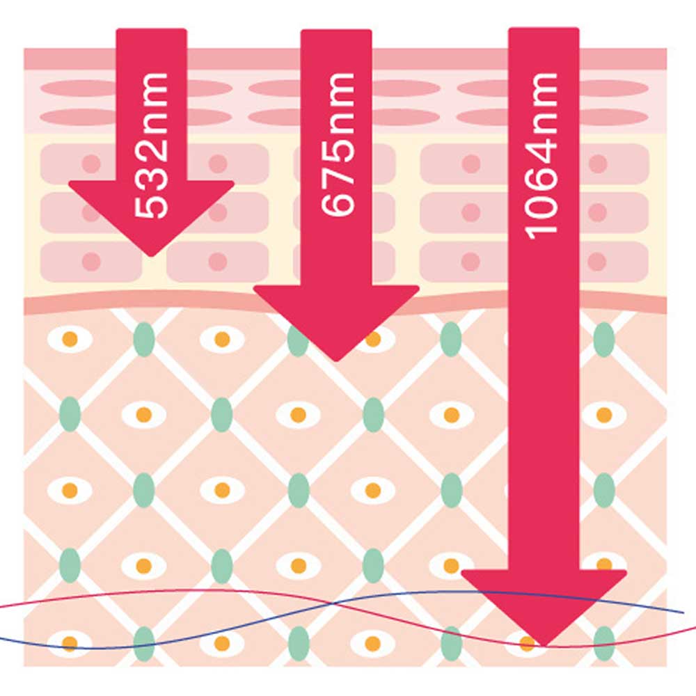 展示不同波長（532nm、675nm、1064nm）激光穿透皮膚的示意圖，強調各波長對皮膚的作用與效果。