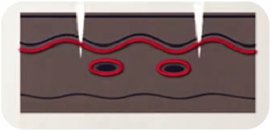 顯示另一種針對皮膚的治療示意圖，強調血管的作用及治療效果。