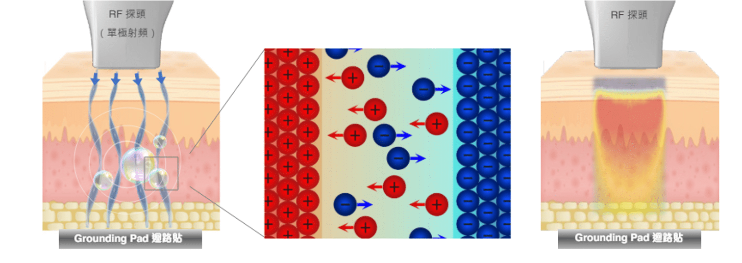RF探頭的工作原理示意圖，顯示射頻能量在皮膚層中的穿透效果，幫助理解射頻美容技術的運作過程。