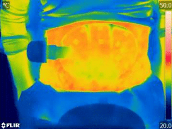 熱成像圖展示FLEXSURE設備在腹部的操作情況，顯示熱量分布和治療效果的可視化。